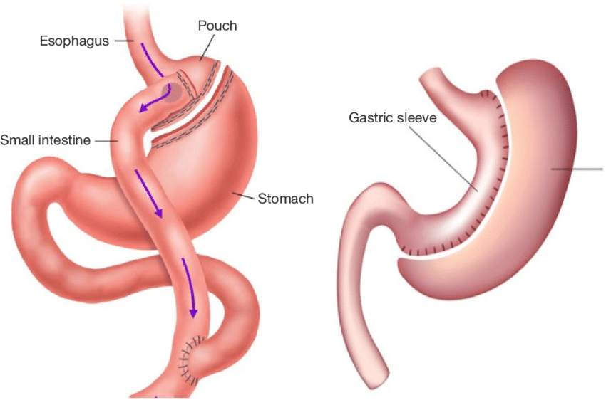 gastrectomy
